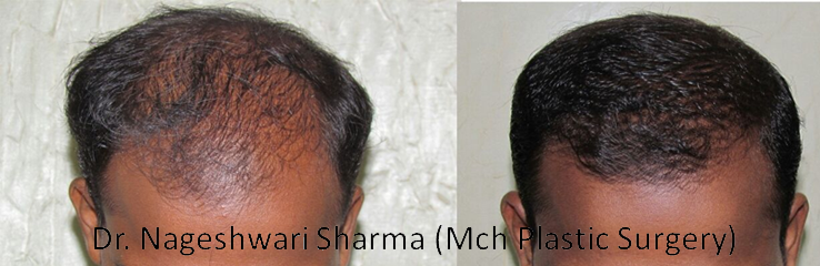 Hair Removal in thane - Relive Clinic